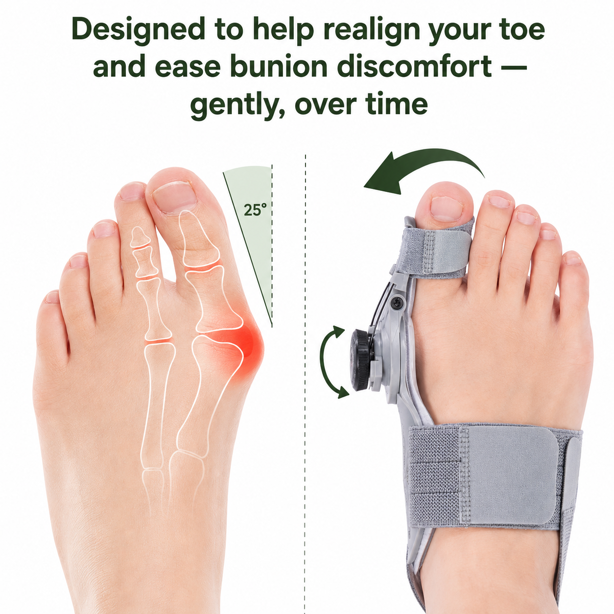 StepEase Bunion Corrector™